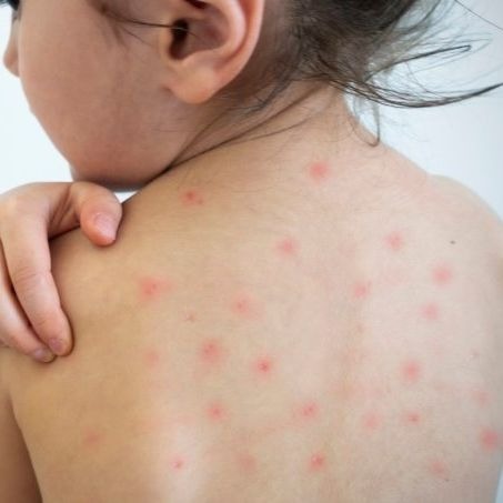 Além dos sintomas já conhecidos, o sarampo faz o sistema imunológico se esquecer de como combater outras infecções